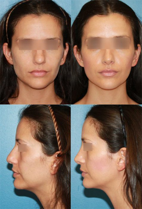 Rhinoplasty Nose Surgery 01 1 e1602325258401
