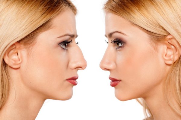Tips For A Speedy Rhinoplasty Recovery Enhancements Cosmetic Surgery e1602325140683
