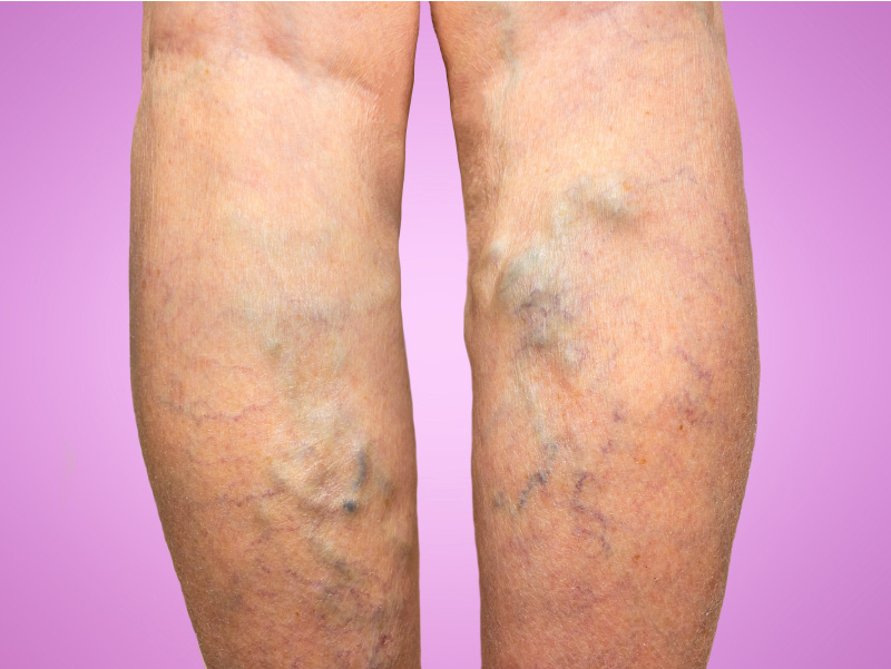 0924varicoseveins_sc