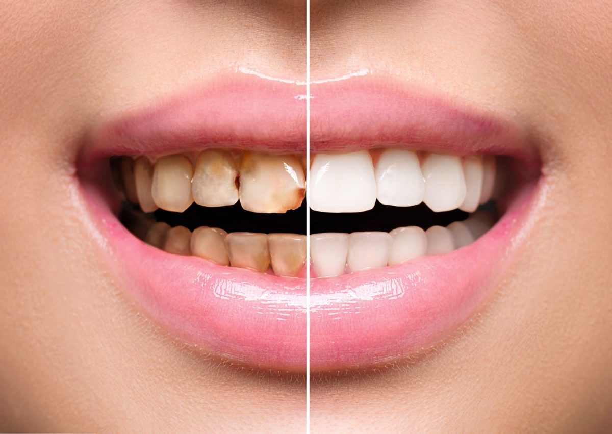 womans-teeth-before-and-after-whitening-oral-care