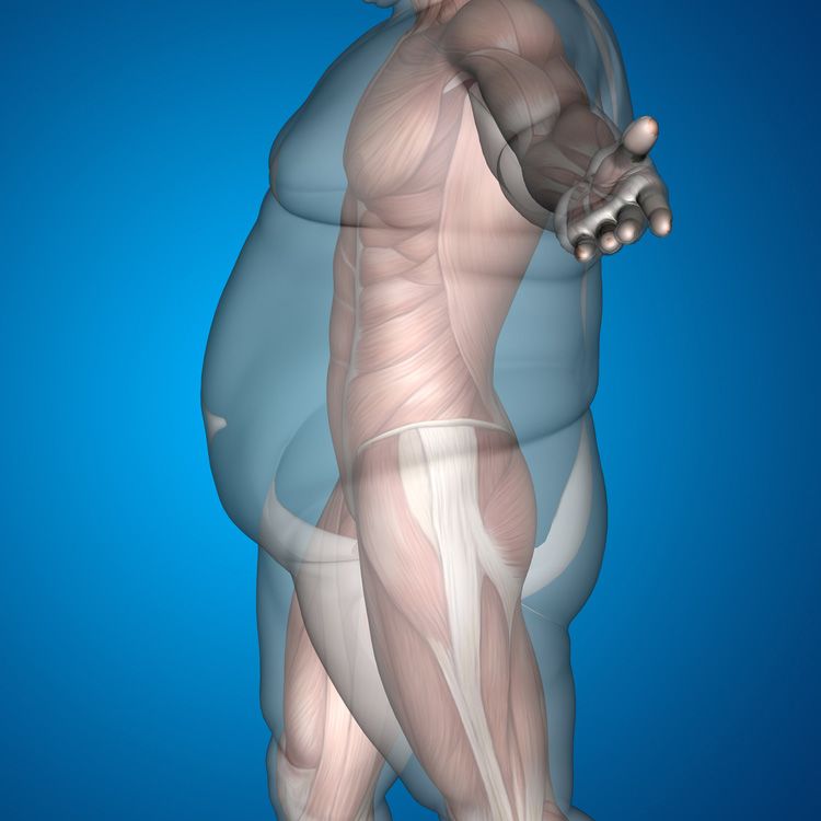 جراحة تخفیف الوزن بطریقة Bariatric