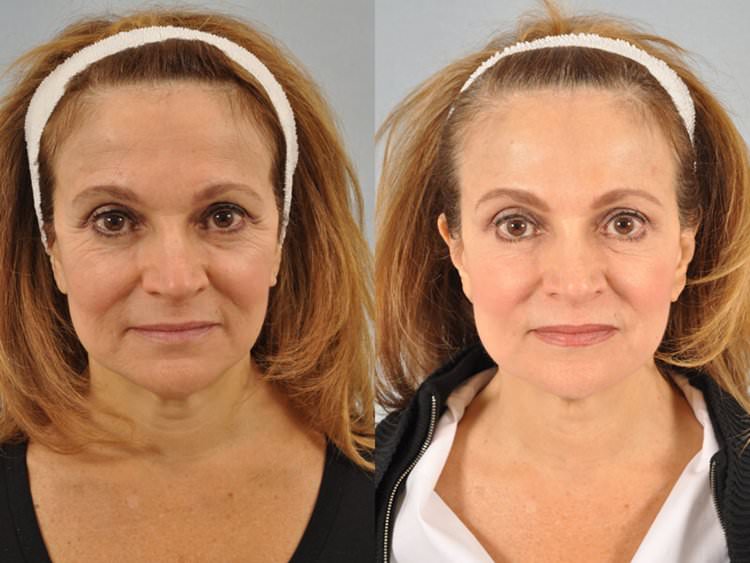 botox-injection-before-and-after-5