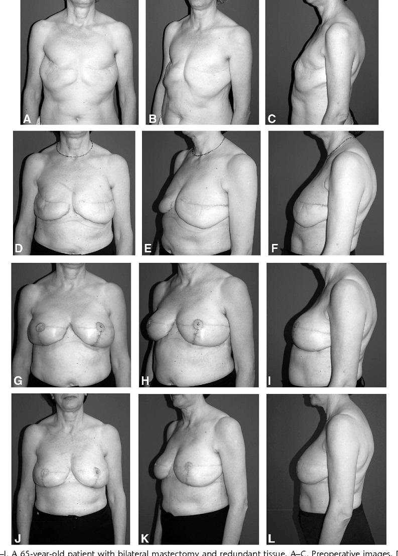 breast-reconstruction-with-fat-grafting-jpg2