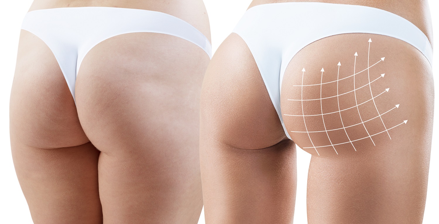 butt-lift-gluteoplasty