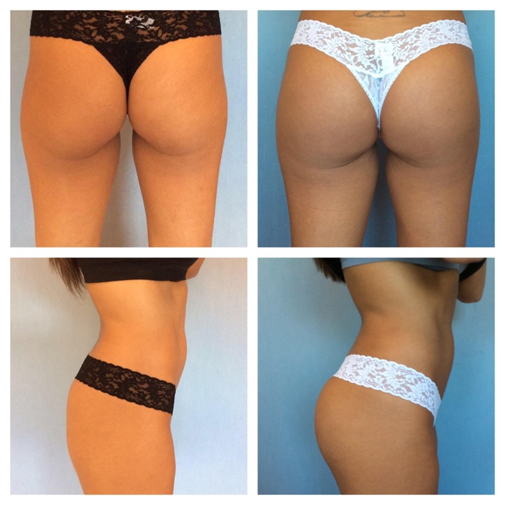 buttock-augmentation-with-fat-grafting