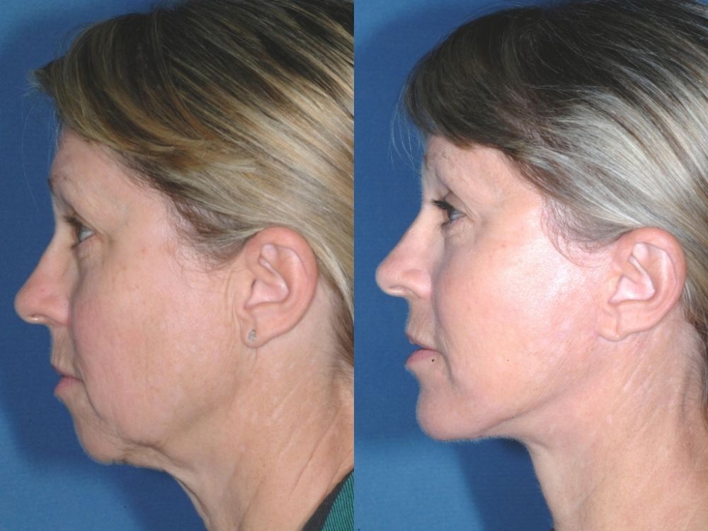 chin-protez-implants22