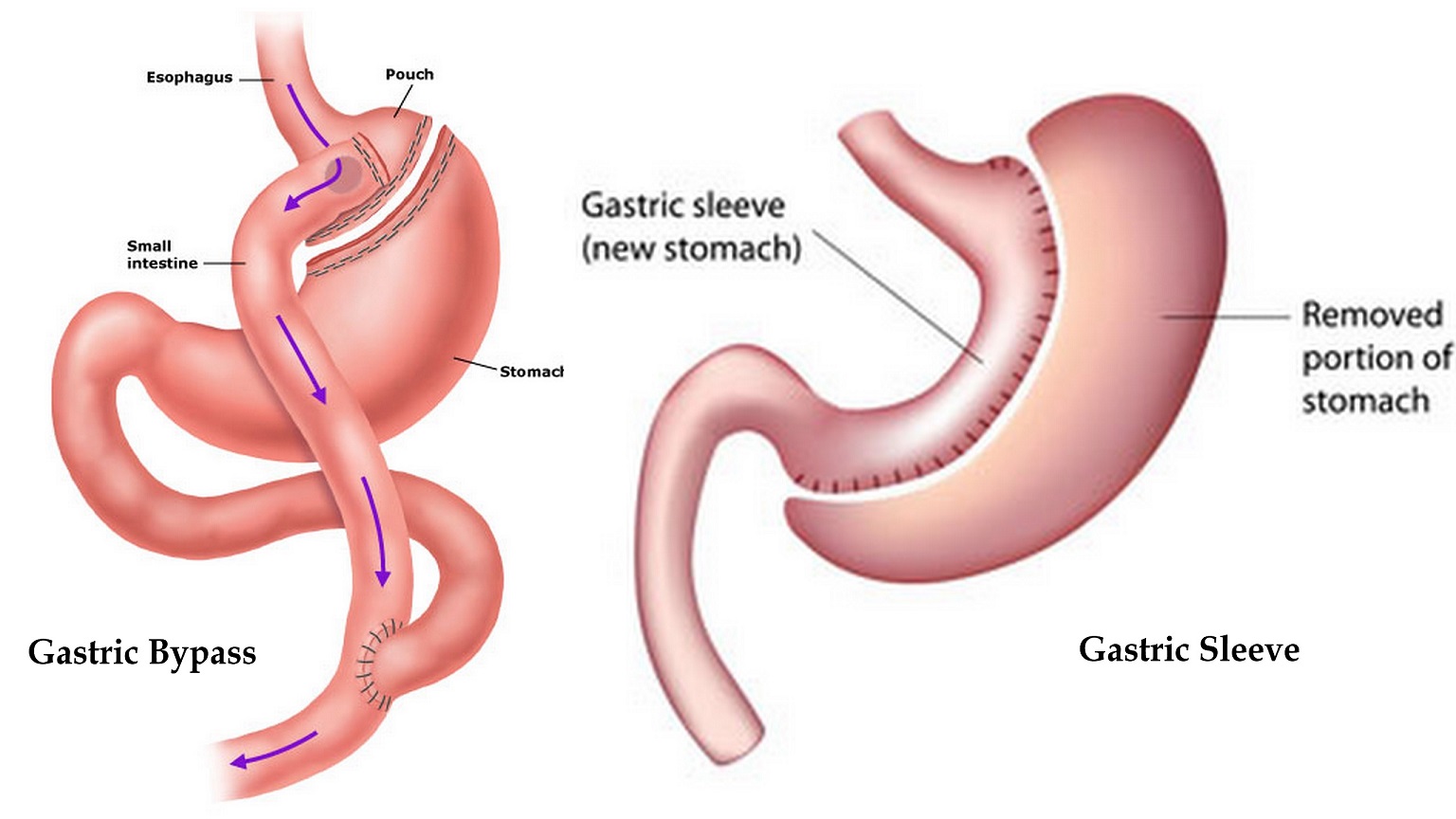 gastric-bypass-vs-gastric-sleeve-weight-loss-surgery