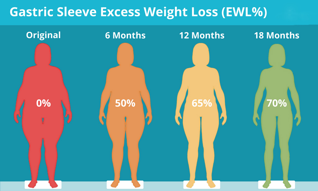 gastric-sleeve-excess-weight-loss-ewl-1