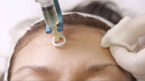 How does Mesotherapy work e1600240575570