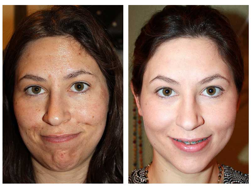 microdermabrasion-before-after-2