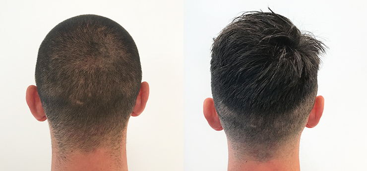 jorge-before-after-his-hair-transplant-donor-area