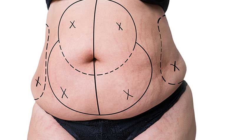 شفط الدهون البطن لیپوساکشن شکم و پهلو