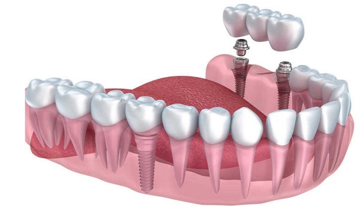 placing-the-dental-implant1