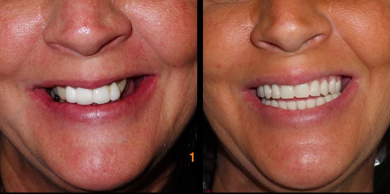 all-on-4-dental-implant-before-and-after