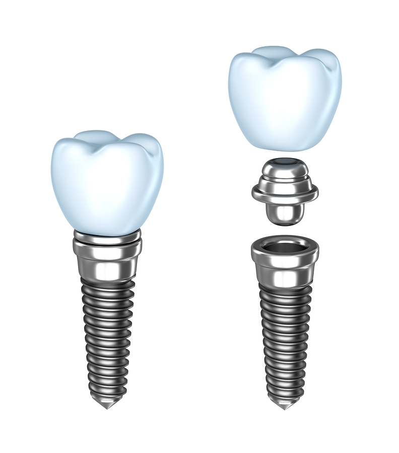 tooth-implant-assembled-and-disassembled-isolated-on-white