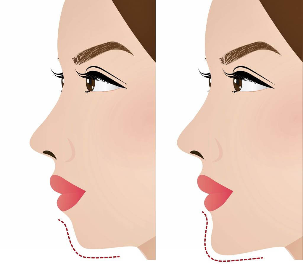 chin-augmentation-genioplasty-1024x890-2