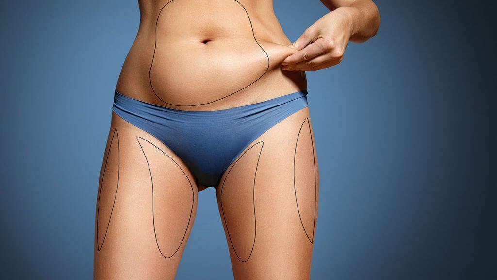 abdominal-liposuction-2-1024x576