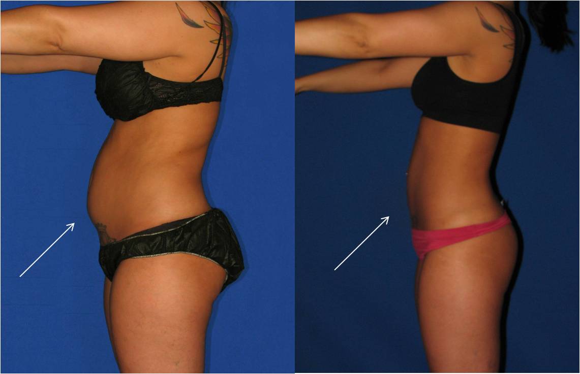 abdominal-liposuction9