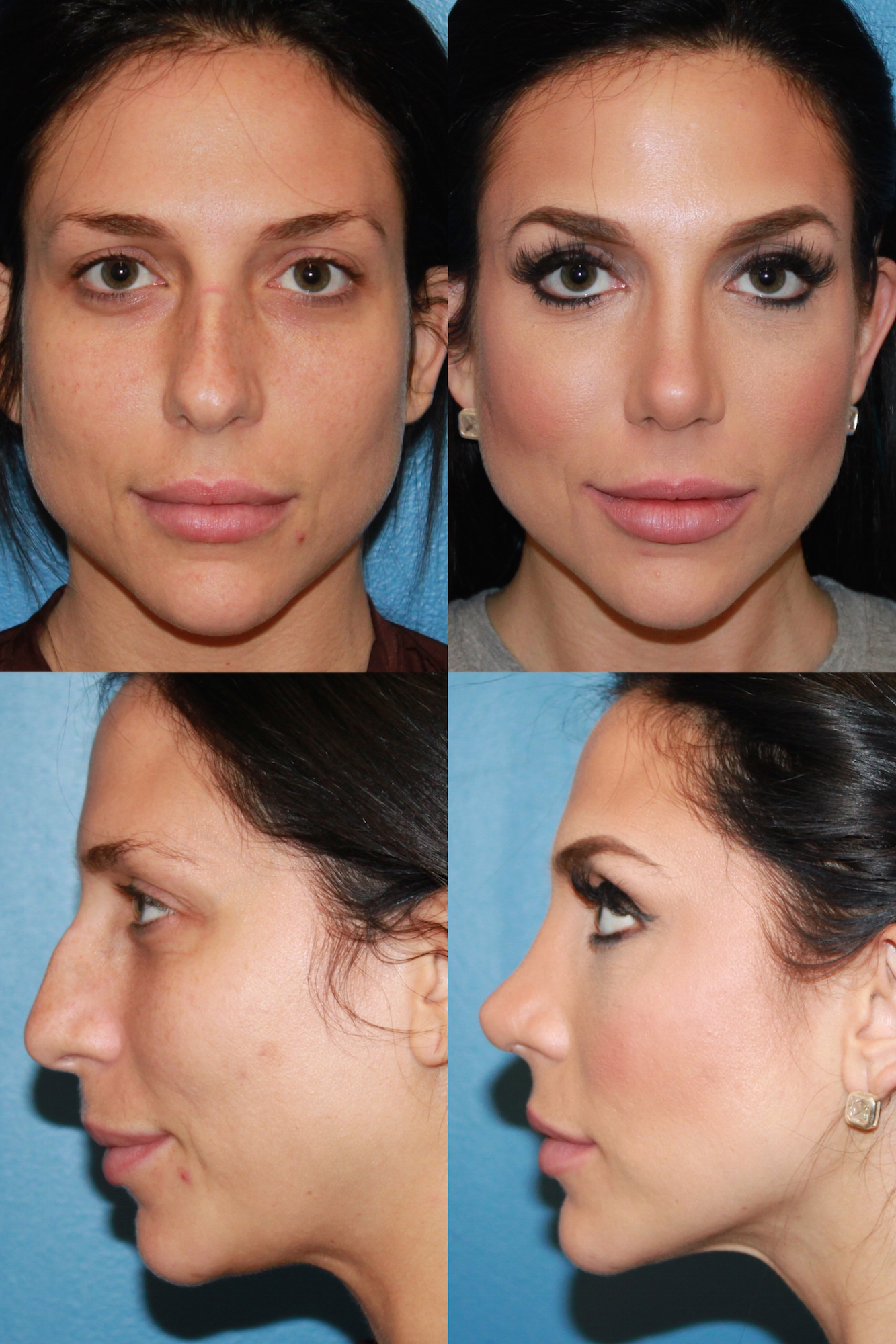 rhinoplastypatient