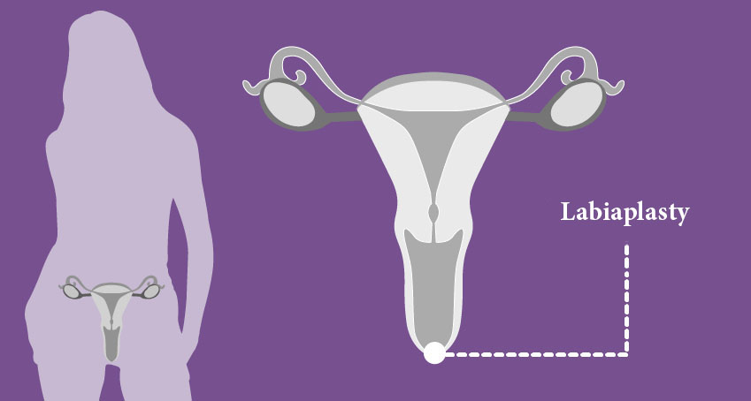 جراحی زیبایی واژن یا لابیاپلاستی