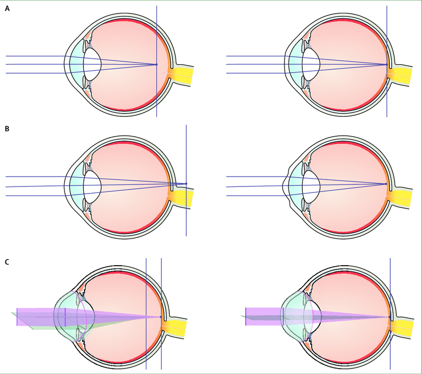 refractive-errors-before-left-and-after-right-surgery-a-refractive-eye-surgery