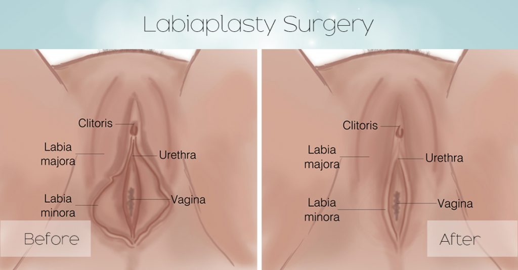 labiaplasty_surgery-1024x534