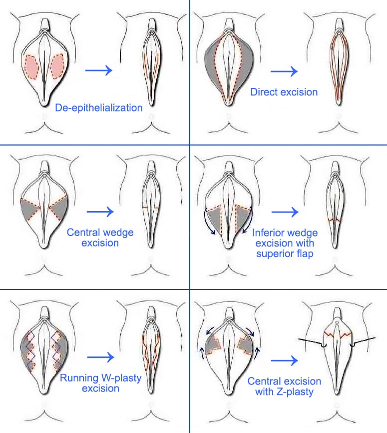 labiplasty-lg-min