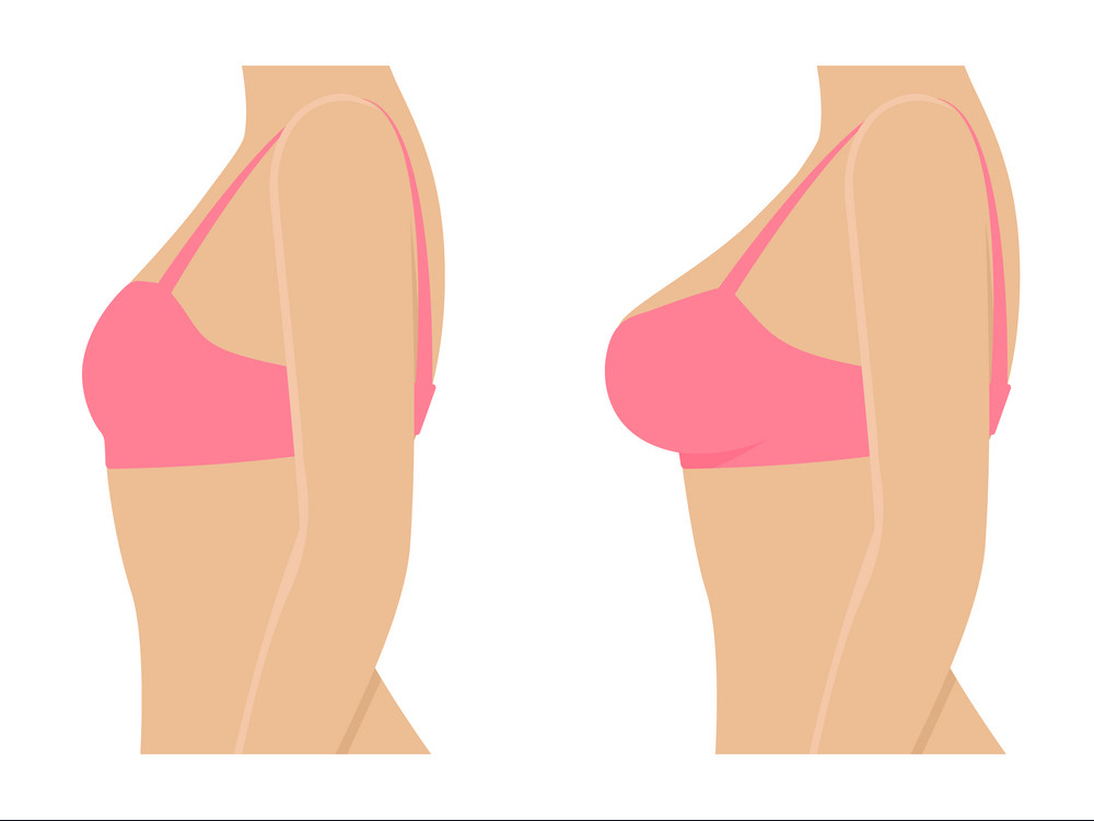 female-breasts-in-bra-before-after-augmentation