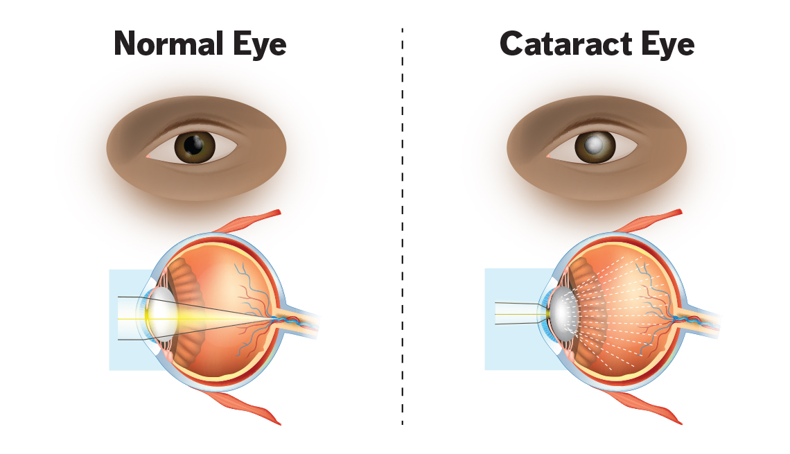 1140-infographic-normal-eye-versus-cataract-eye-imgcache-rev8f6f1c256de898f611fa165533b345b3-1