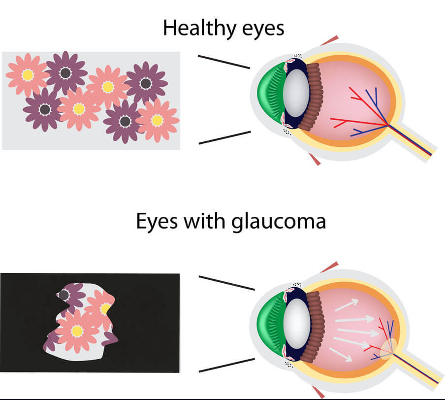 glaucoma