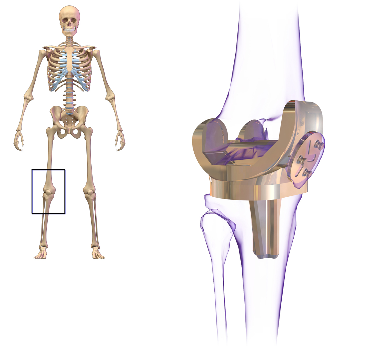 knee_replacement