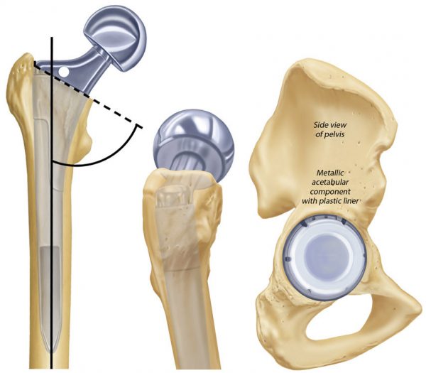 Total Hip Replacement e1601805093821