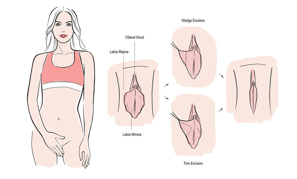 labiaplasty-1