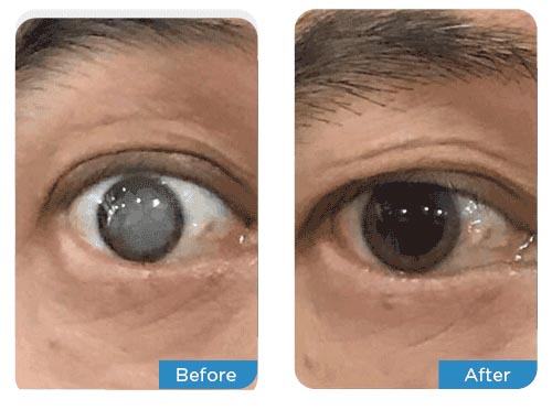 ophthalmologists-cataract-2-before-after-medical-tourism22