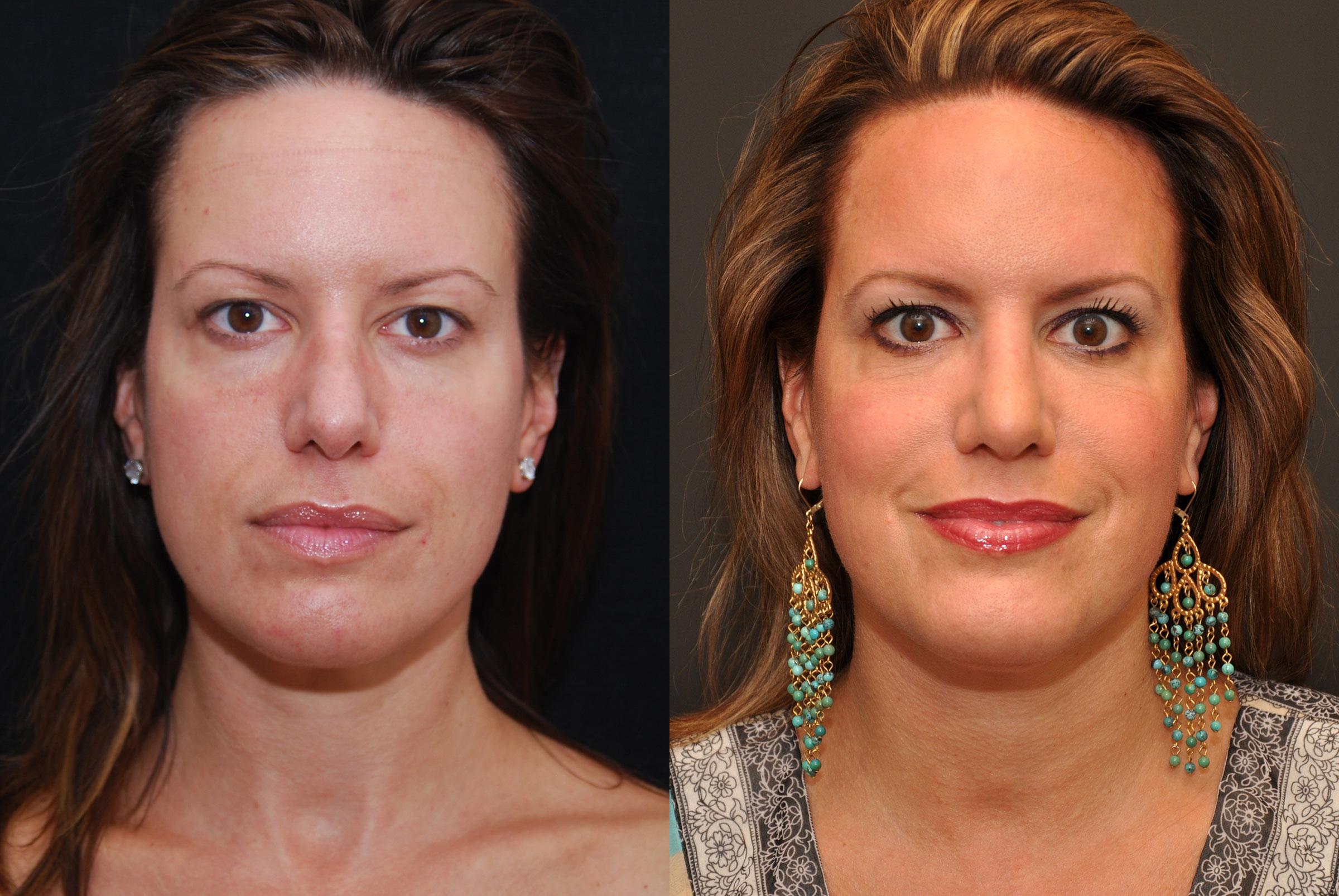 patient-6875-rhinoplasty-nose-reshaping-before-after