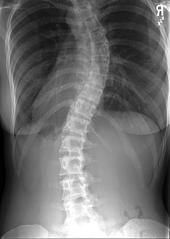 scoliosis