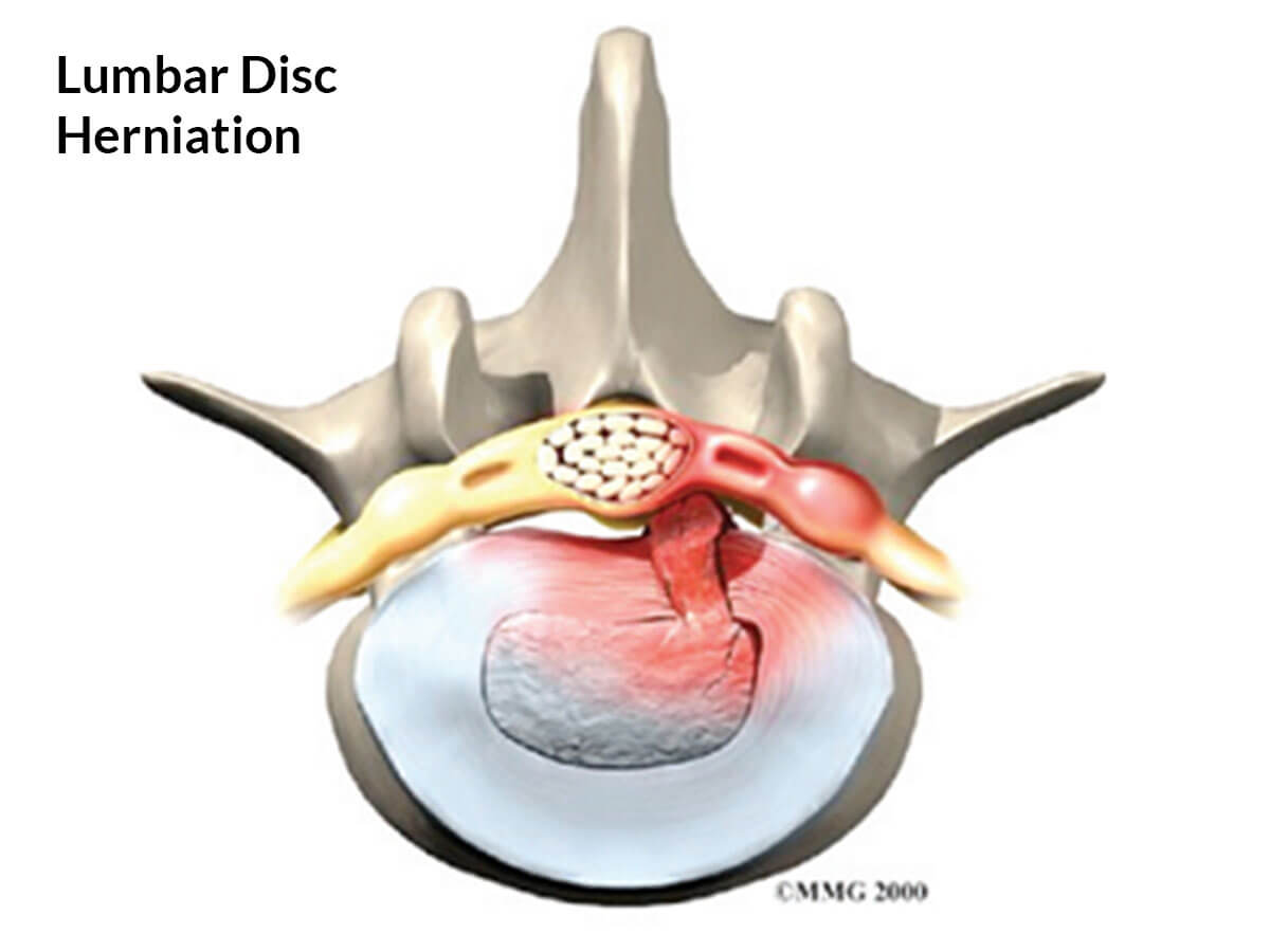 understanding-lumbar-disc-prolapse-and-lumbar-discectomy-2