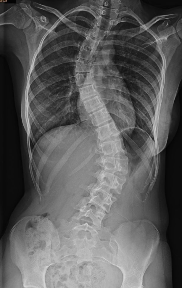 xray-spine-cropped