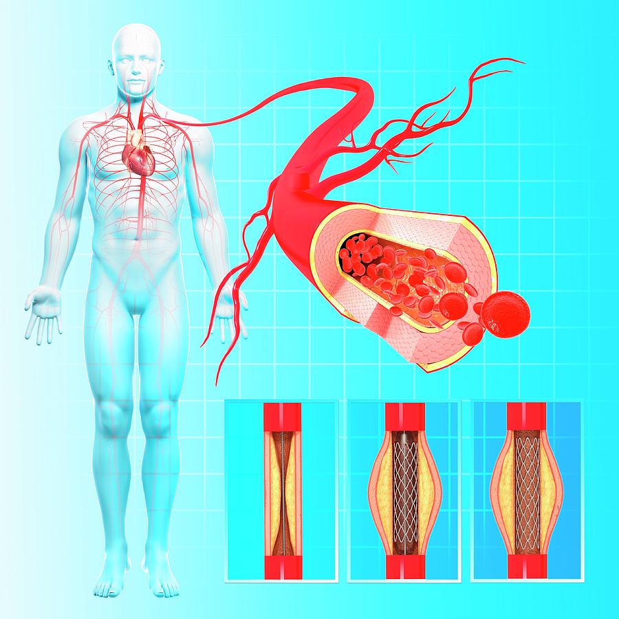 51-angioplasty-pixologicstudioscience-photo-library