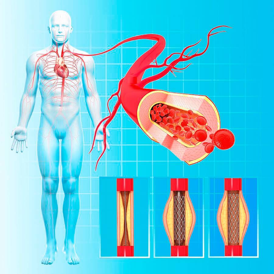 51-angioplasty-pixologicstudioscience-photo-library