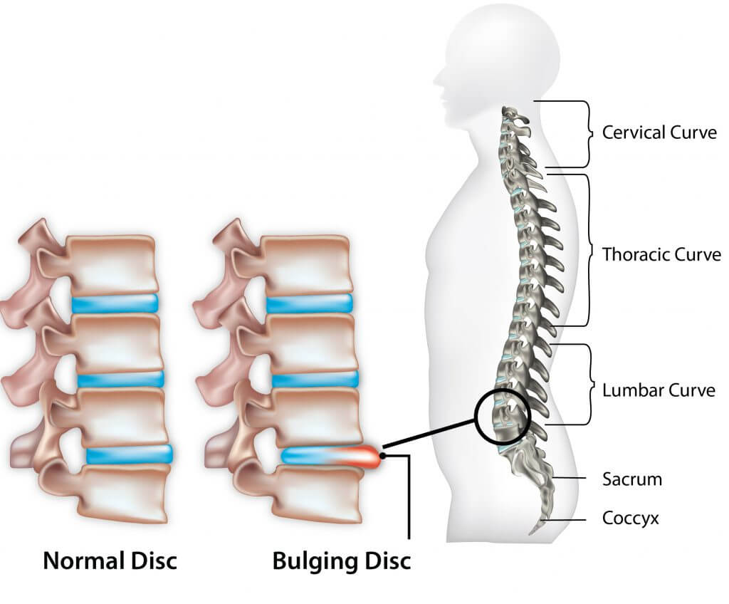 herniated-disc-1024x848