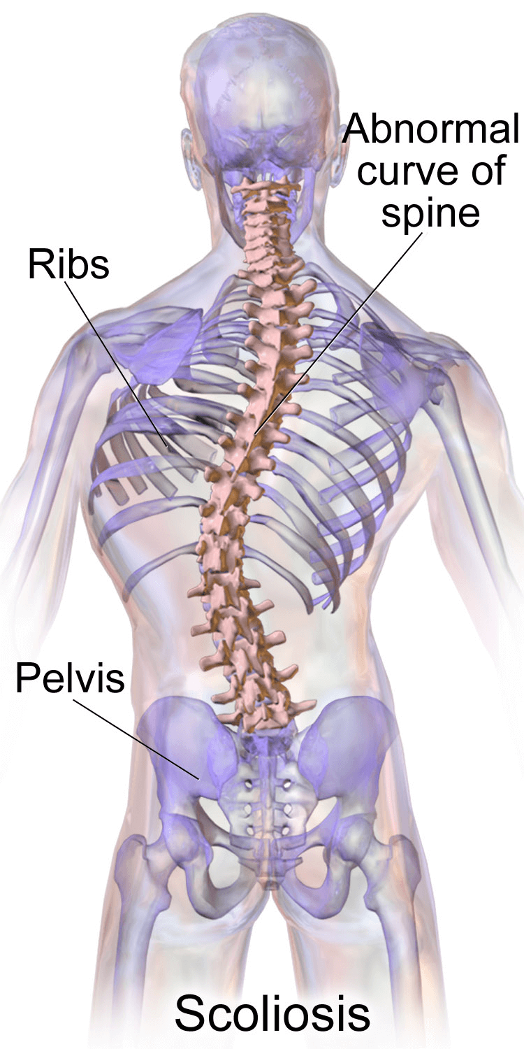 blausen_0785_scoliosis_01-2