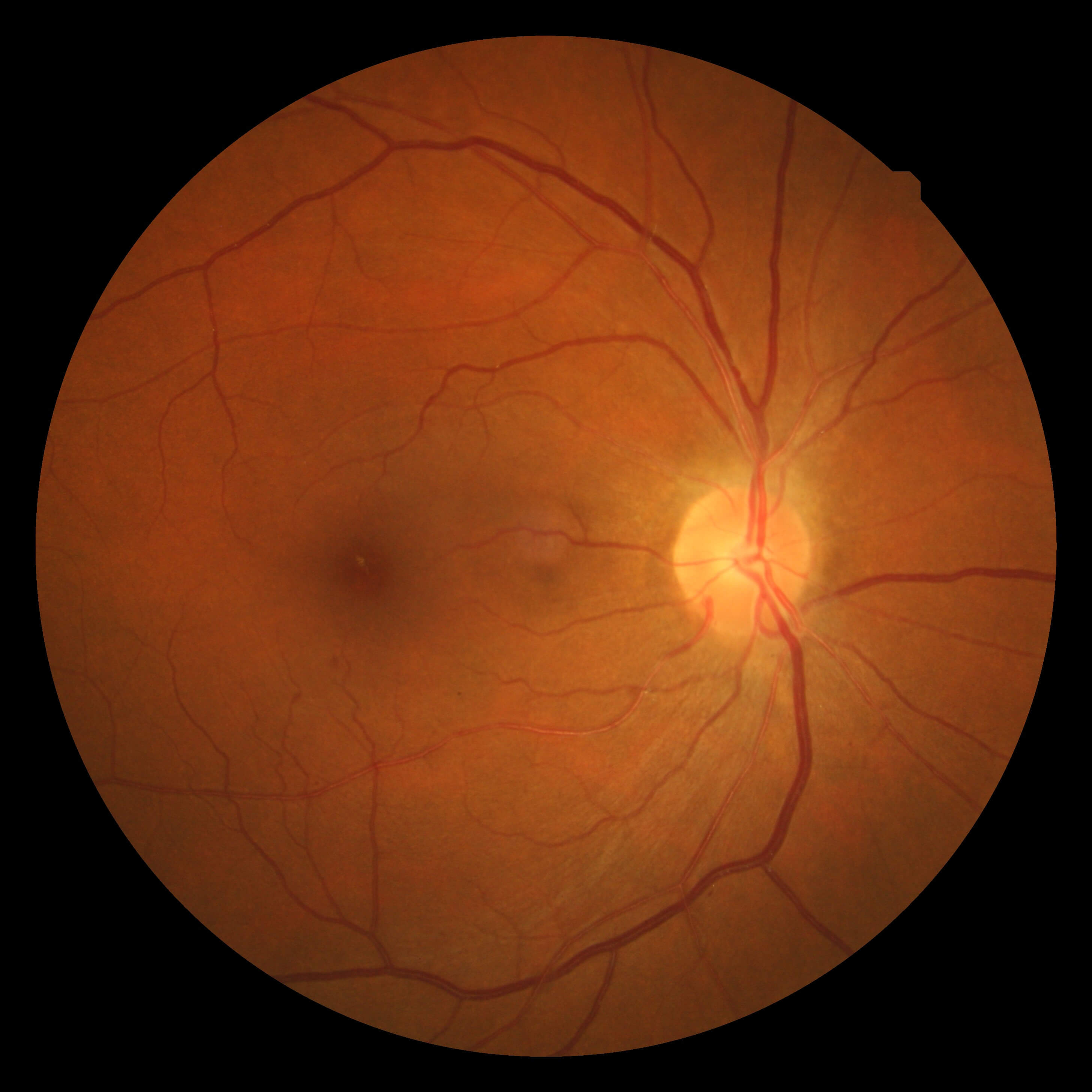 hypertensiveretinopathy-2