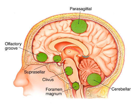 تومور مغزی أورام الدماغ