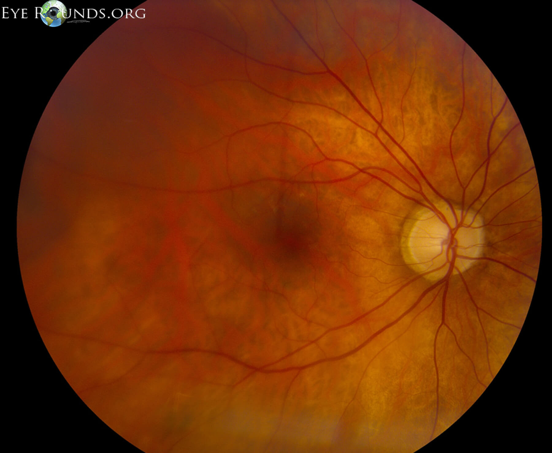 rhegmato-ret-detach-macula-off-1-lrg-2