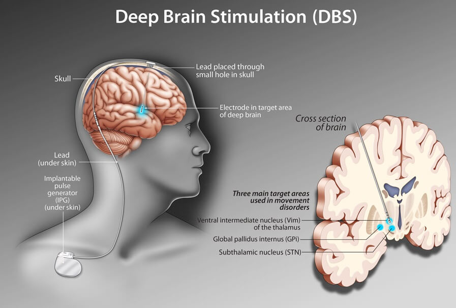 التحفيز العميق للدماغ (DBS) لعلاج مرض باركنسون تحریک عمیق مغزی DBS