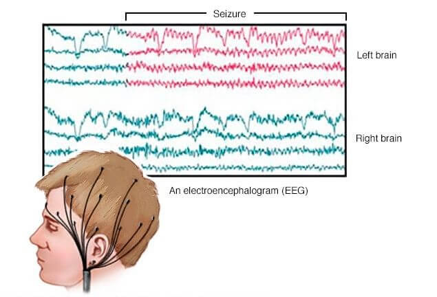التخطيط الكهربائي للدماغ نوار مغز EEG