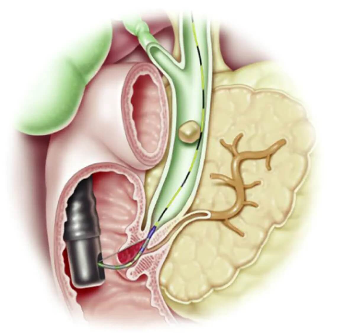 ercp-figure-2-2