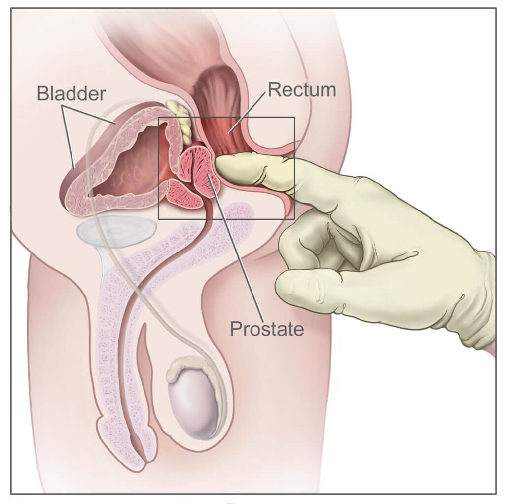 پروستاتکتومی الاستئصال الجذري للبروستاتا المفتوحة