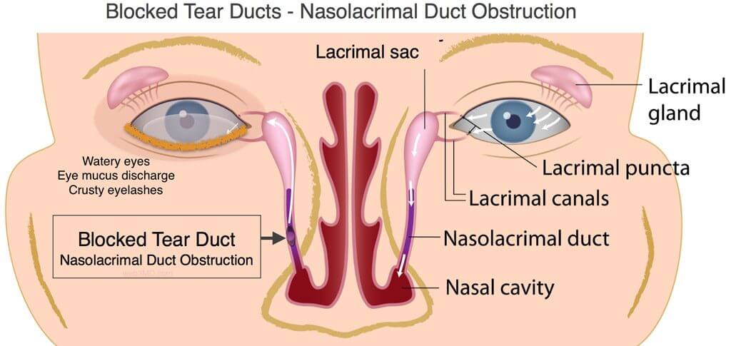 tear-duct-obstruction-1024x485-2